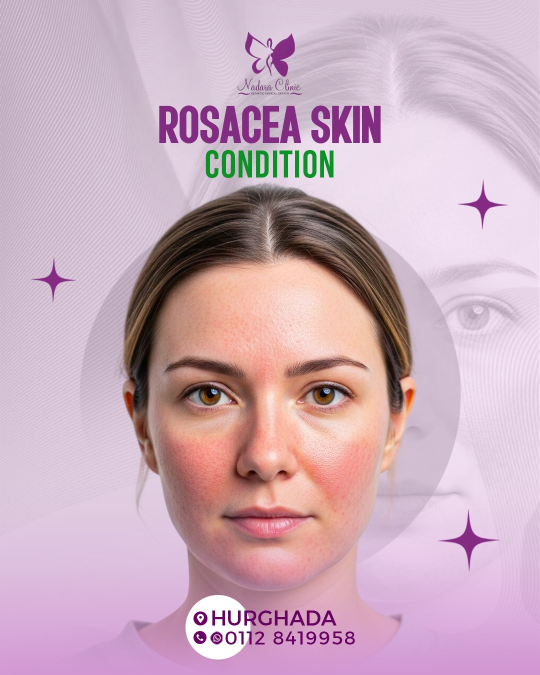 Rosacea in Hurghada